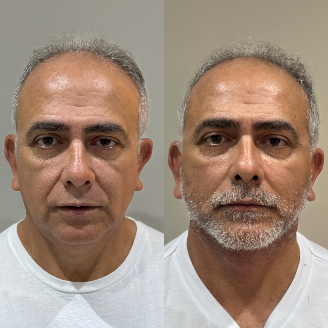 Galeria de resultados — antes e depois