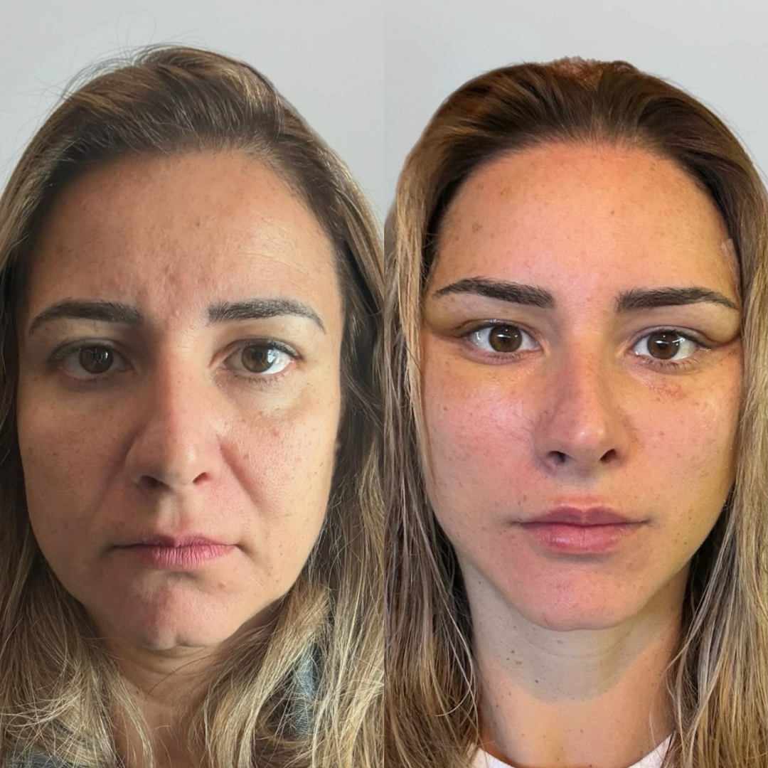 Galeria de resultados — antes e depois