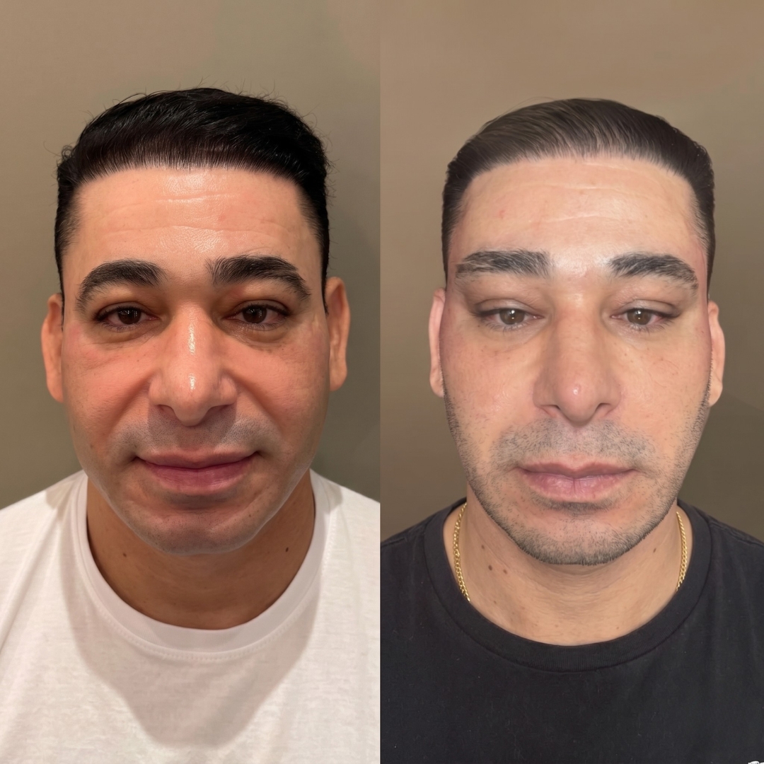 Galeria de resultados — antes e depois