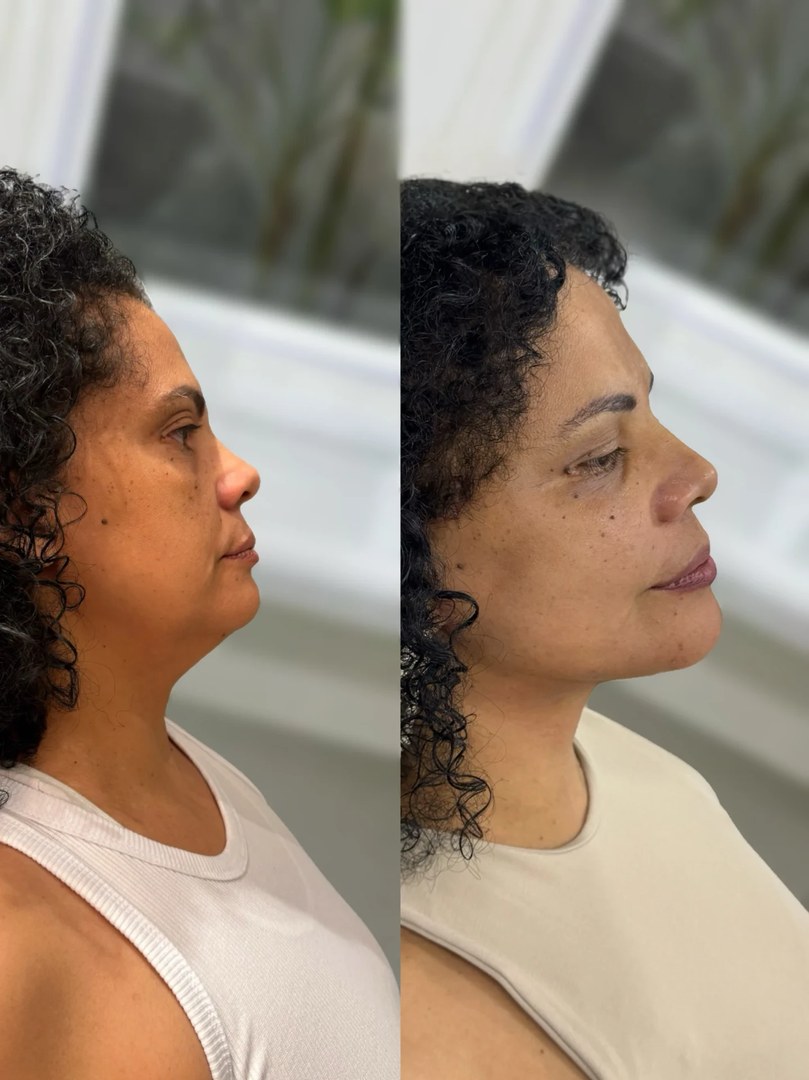 Galeria de resultados: antes e depois