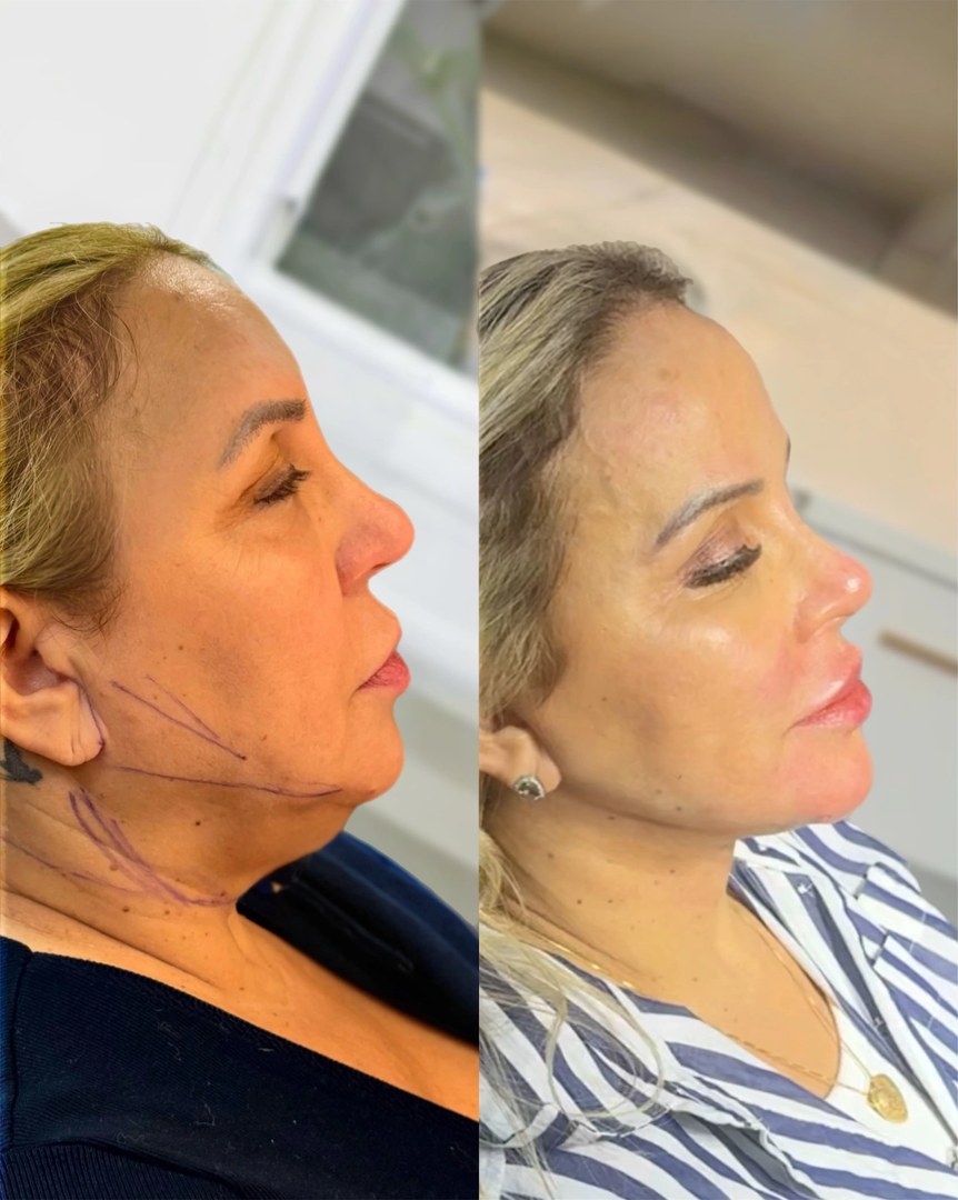 Galeria de resultados: antes e depois