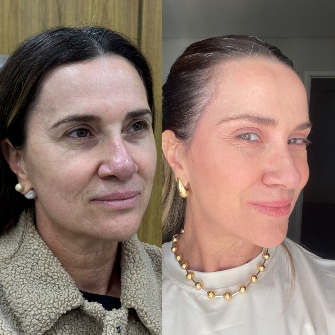Galeria de resultados — antes e depois