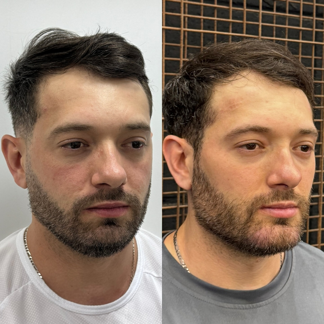 Galeria de resultados — antes e depois